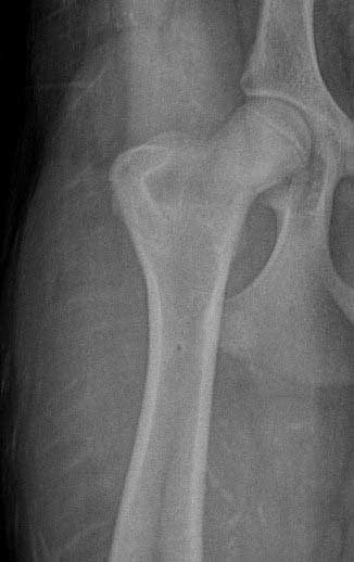 Normal hip
