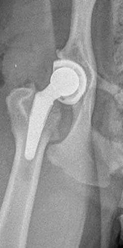 Post-op Total Hip Replacement
