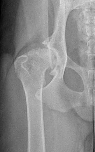 X-ray of hip with severe arthritis